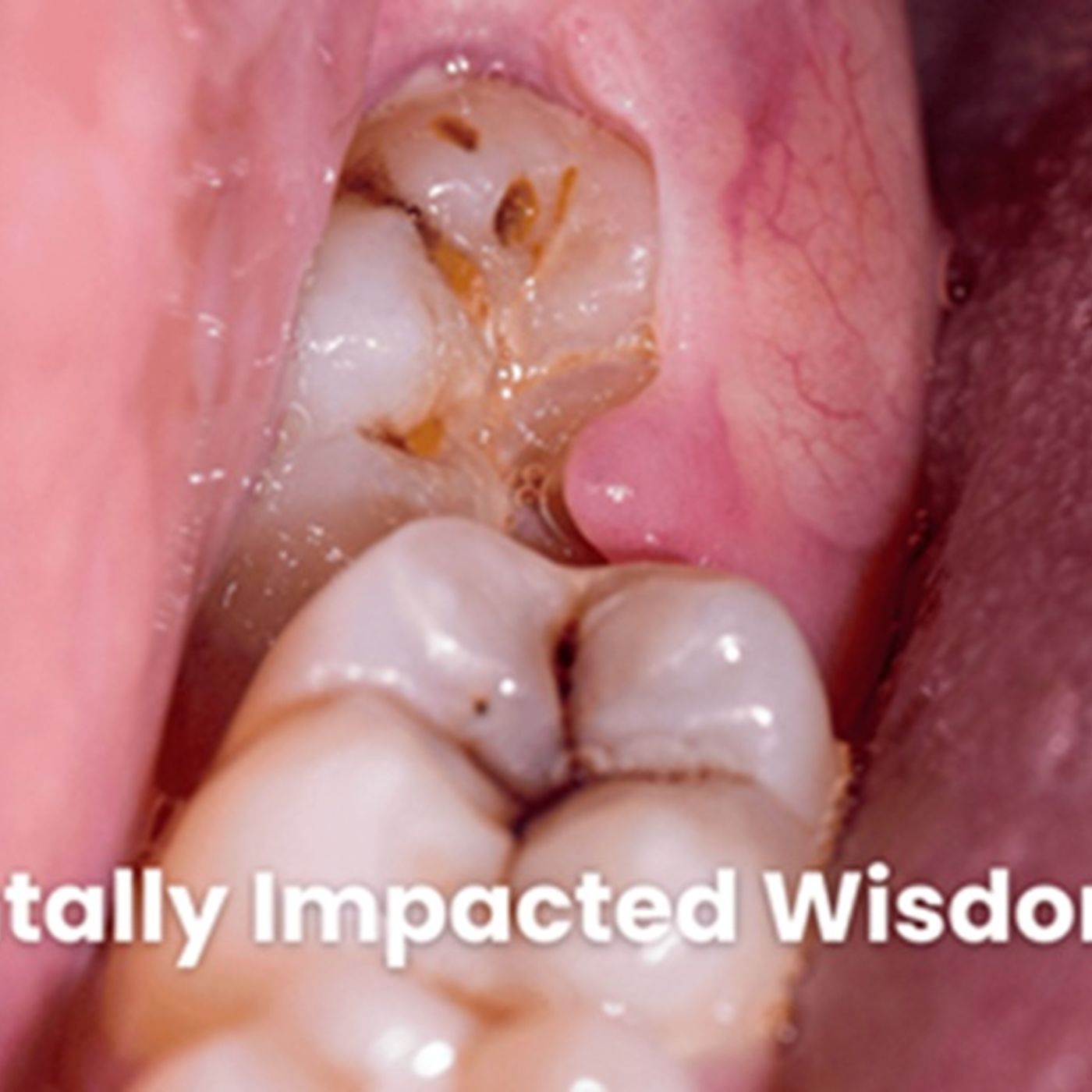 The Hidden Danger of Horizontally Impacted Wisdom Teeth episode artwork
