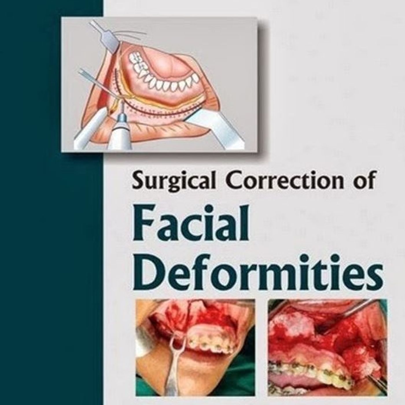Surgical Correction of Facial Deformities