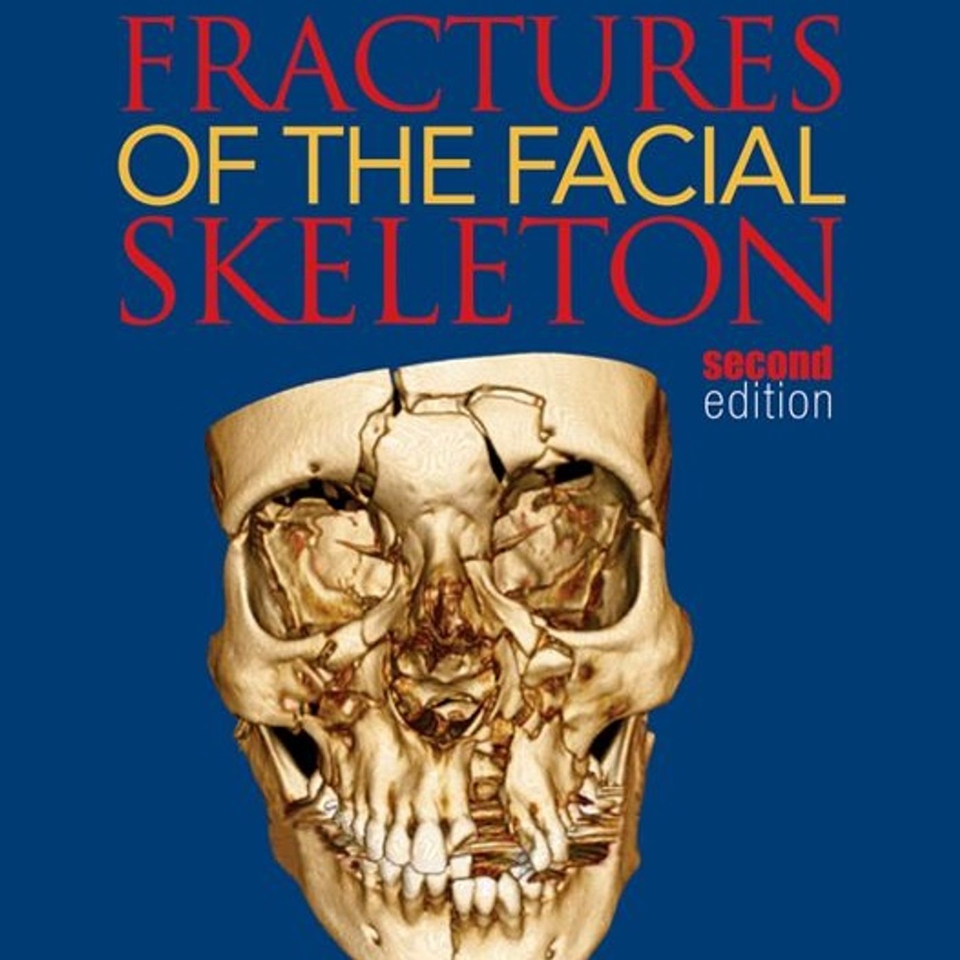 Fractures Of The Facial Skeleton