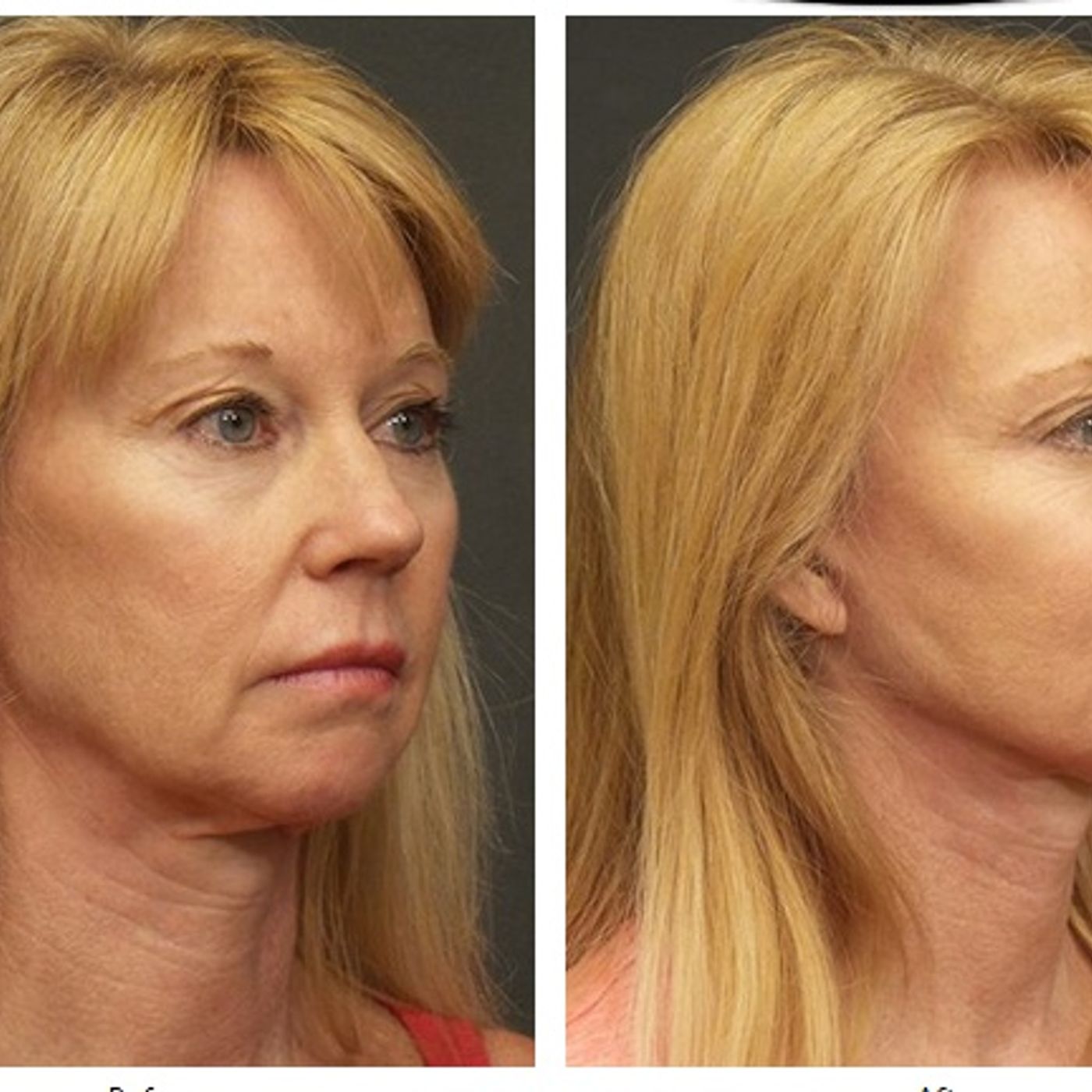 breast augmentation inbellevue