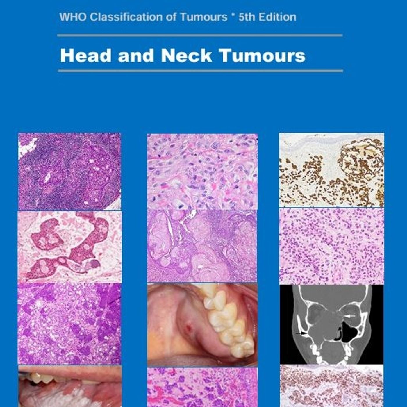 Head and Neck Tumours