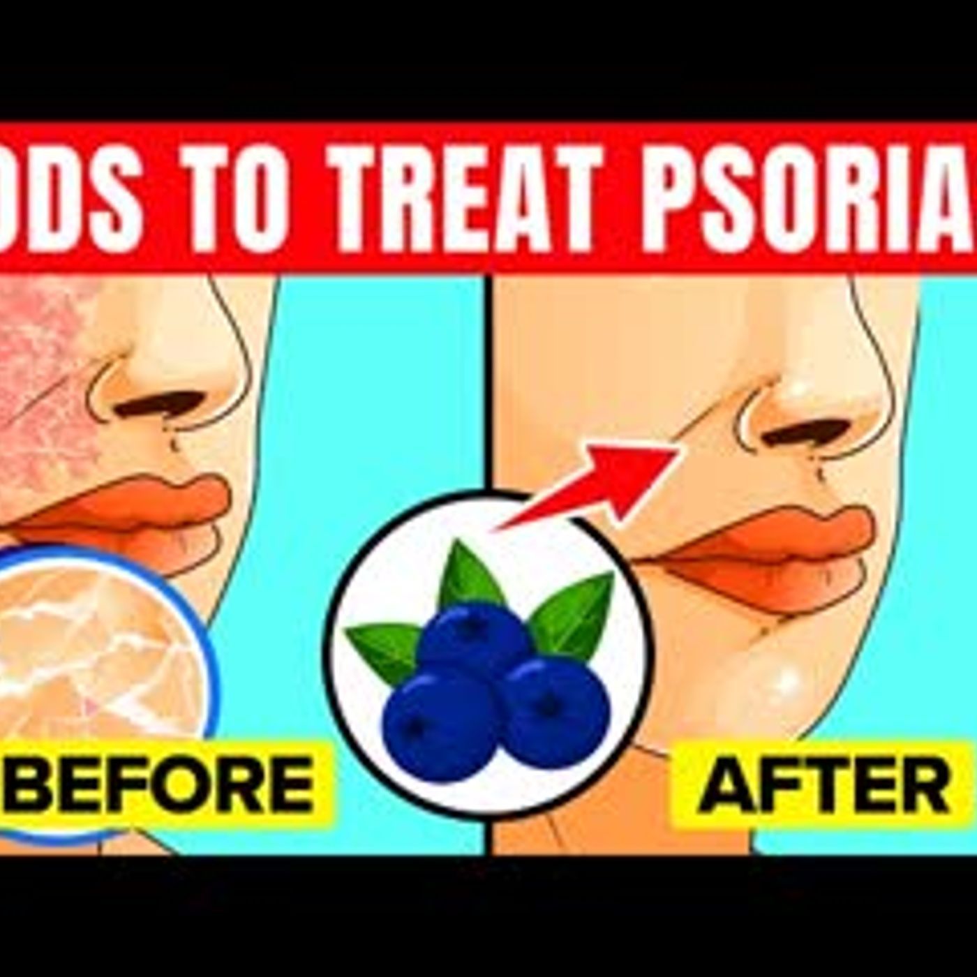 10 Foods That Can Help With Psoriasis episode artwork