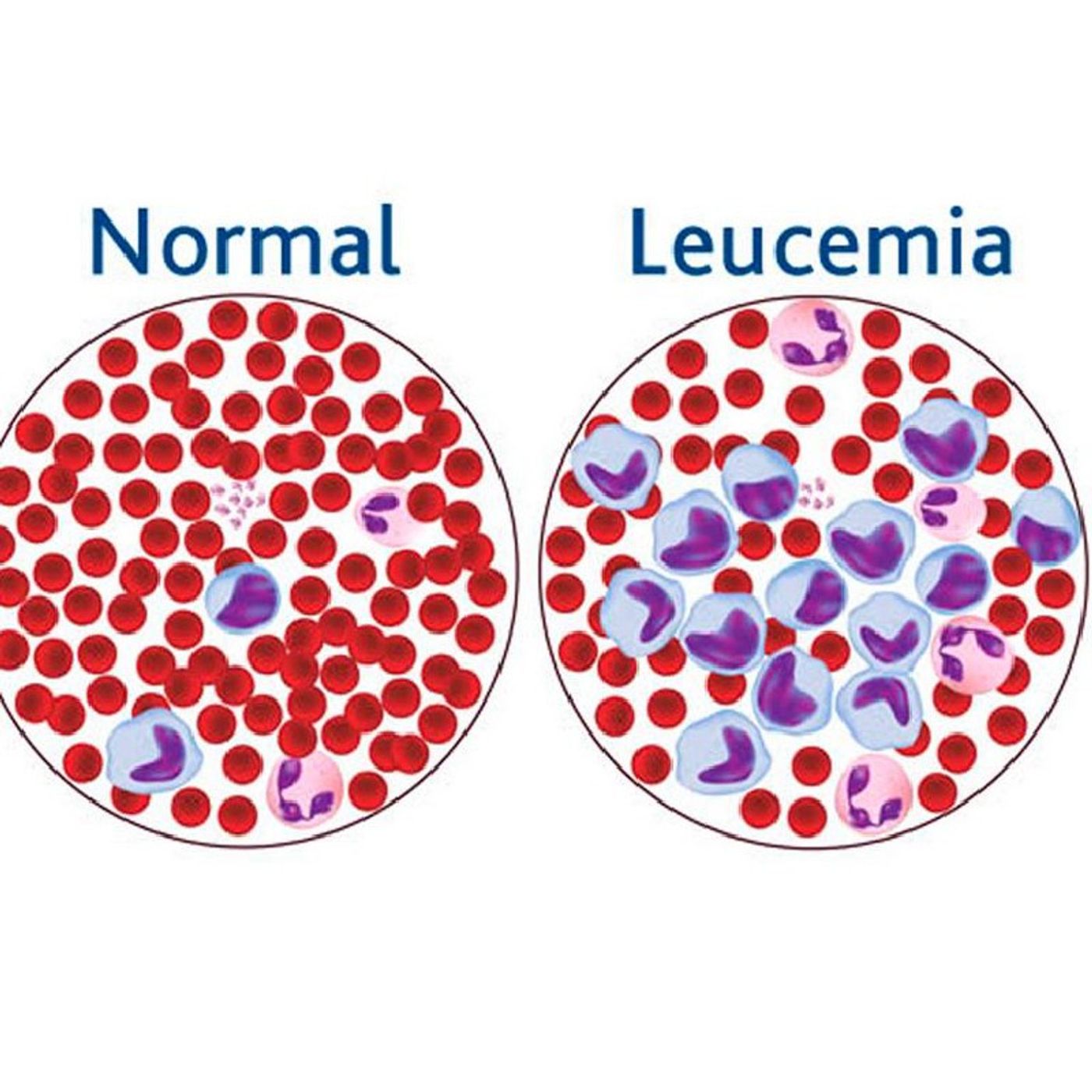 Información sobre la leucemia episode artwork