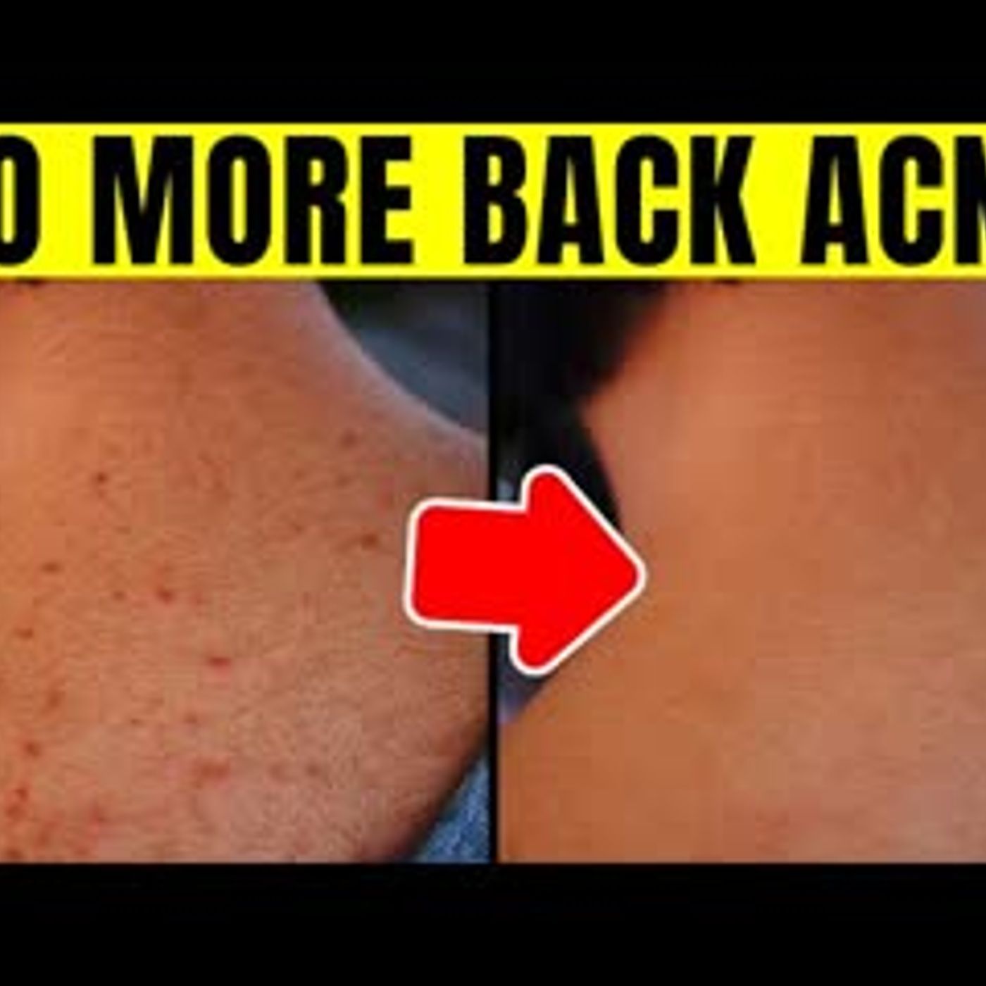13 Ways To Get Rid Of Body Acne For Good episode artwork