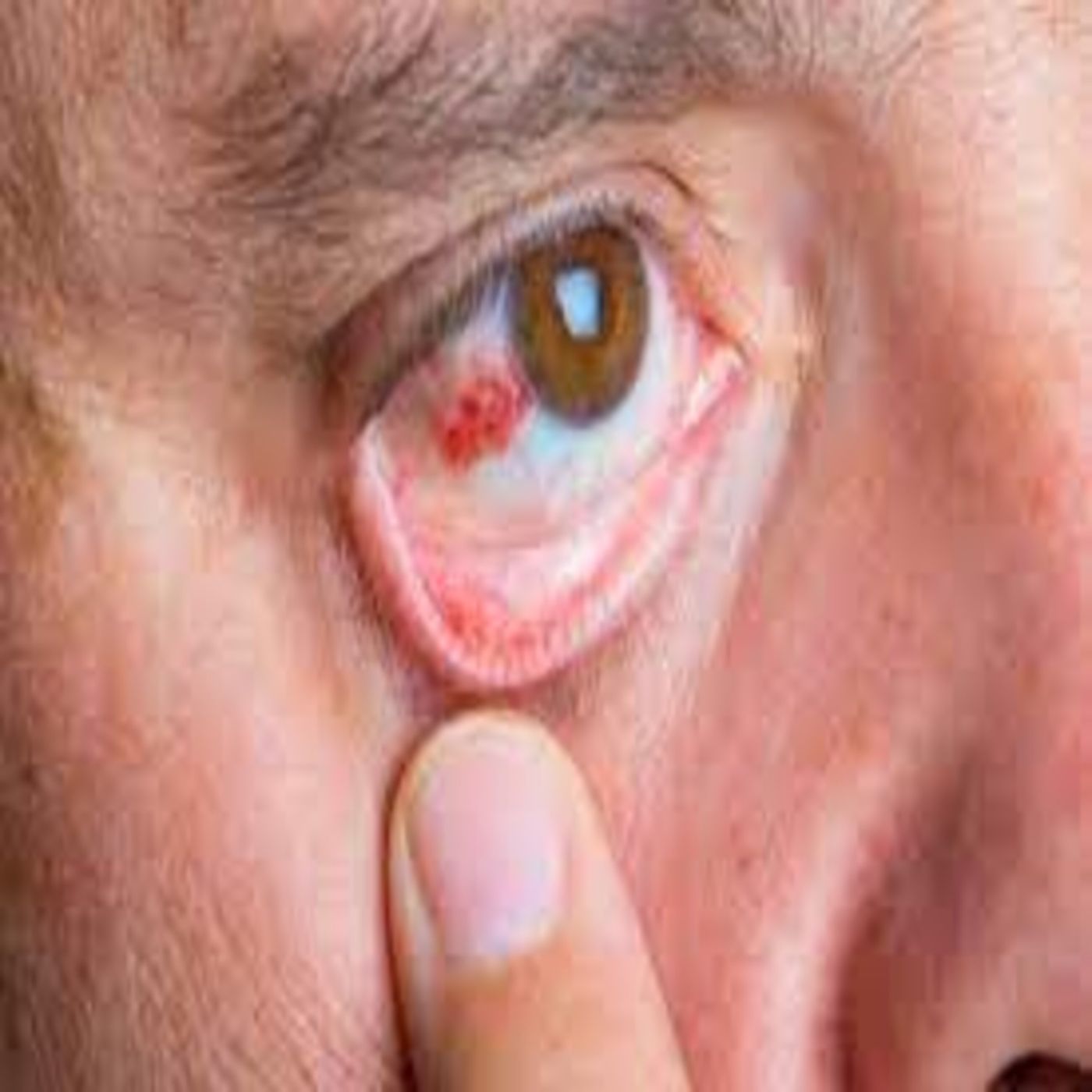 E9 Primeros Auxilios Abrasión corneal qué es episode artwork