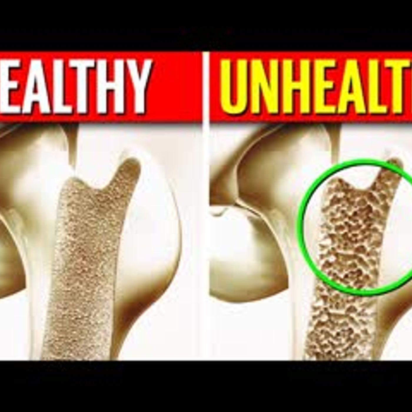 11 POWERFUL Bone Building Foods To RESTORE Your Bone Loss episode artwork