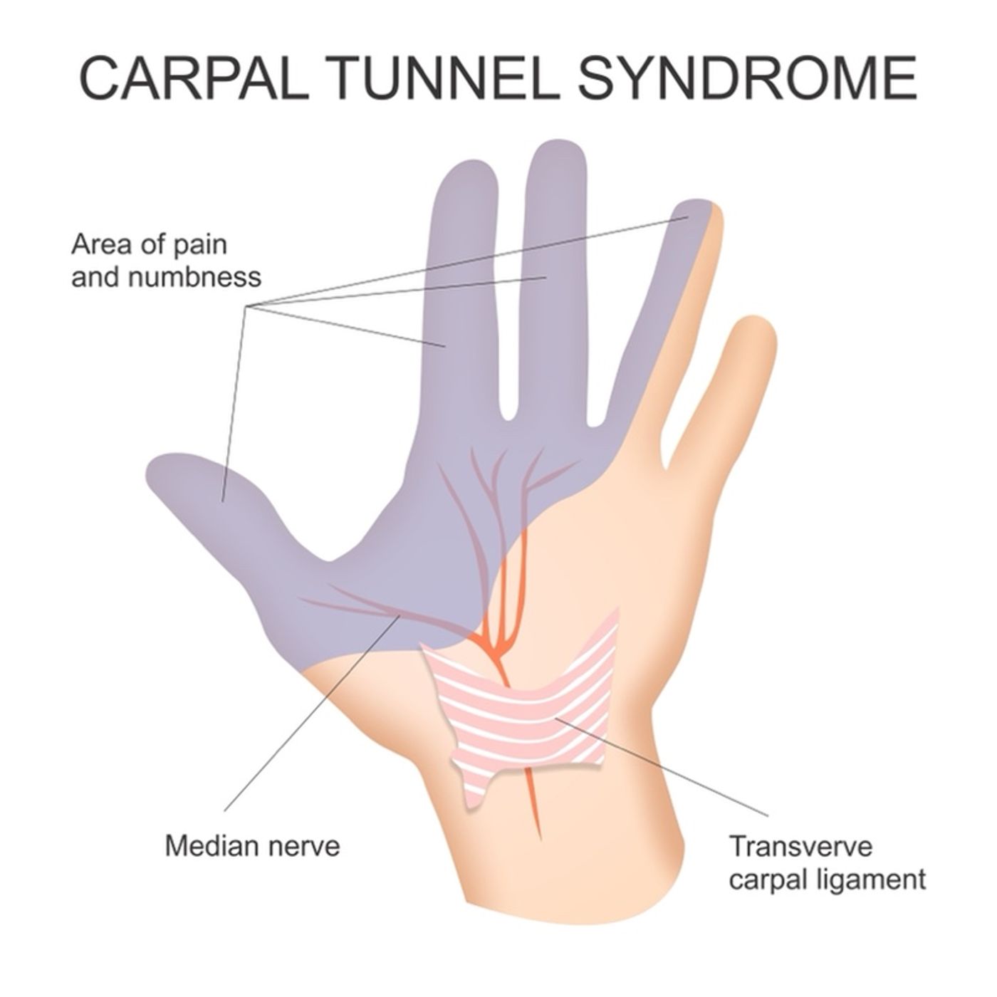Carpal Tunnel Syndrome