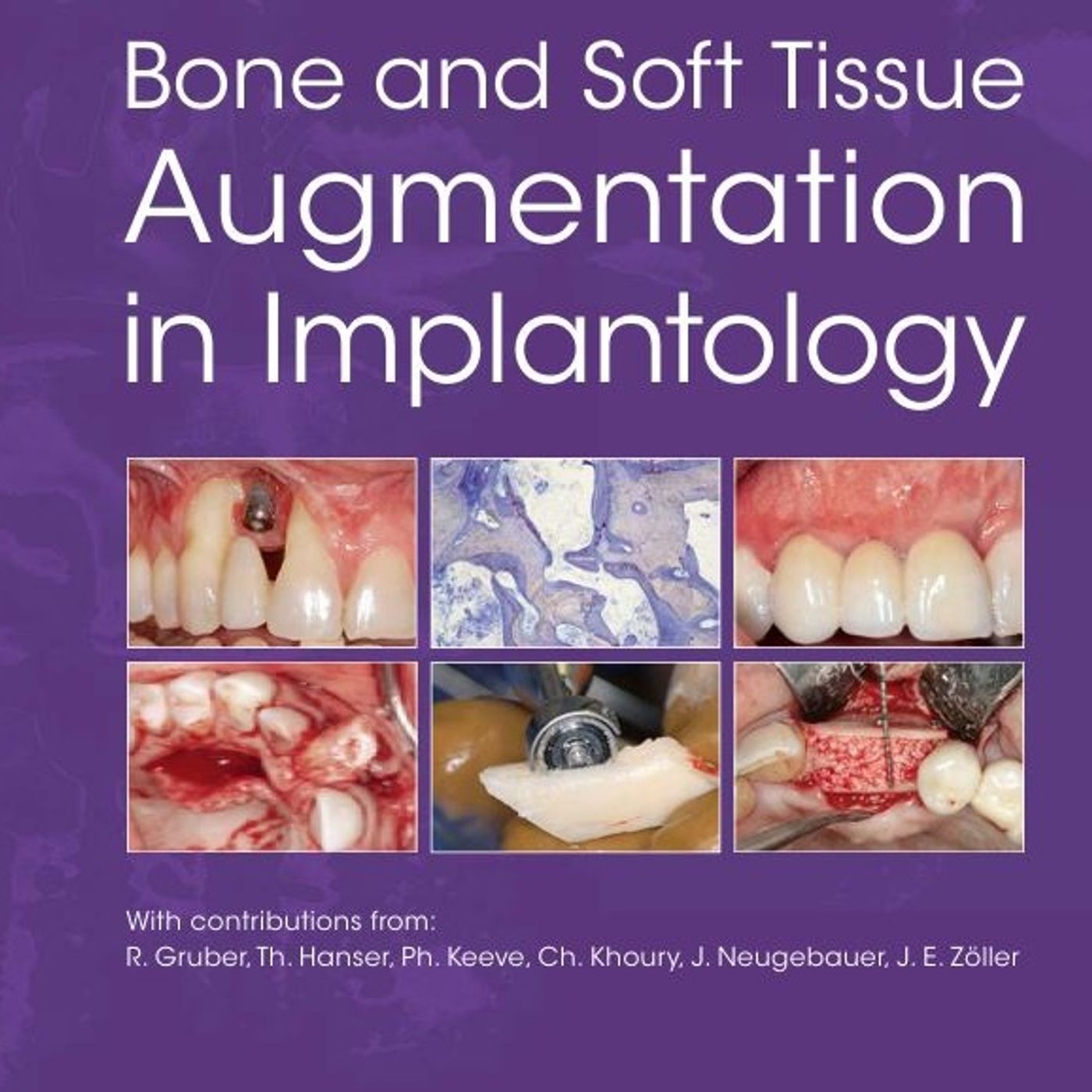 Bone and Soft Tissue Augmentation in Implantology