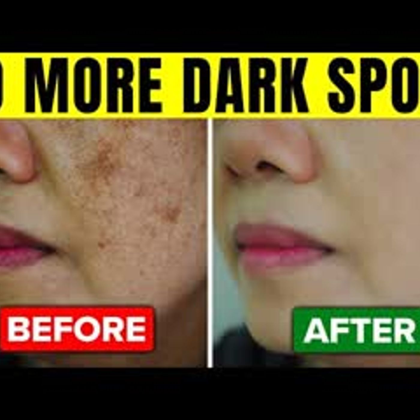 11 Home Remedies To Help Get Rid Of Your Dark Spots episode artwork