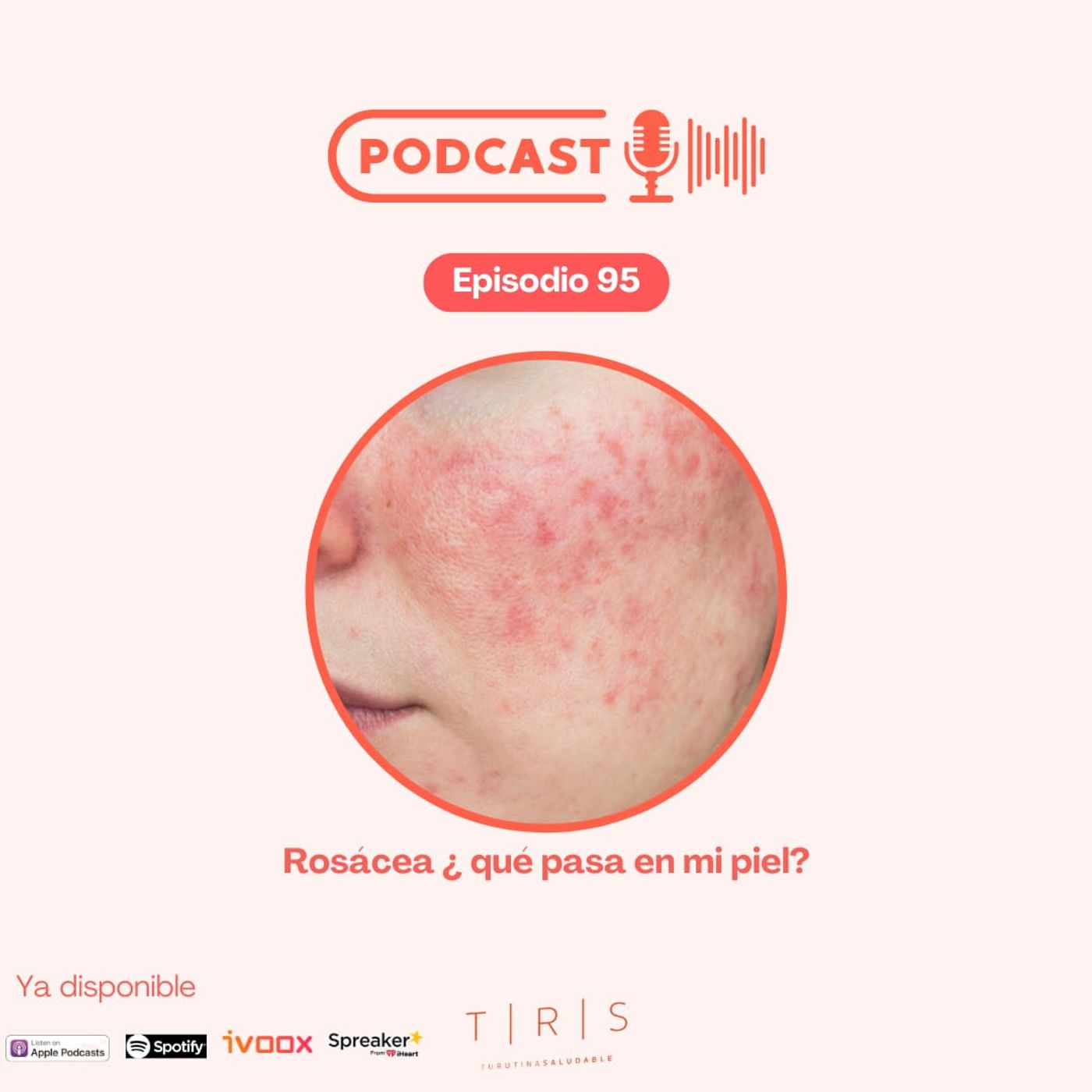 95 - Rosácea, ¿qué pasa en mi piel?