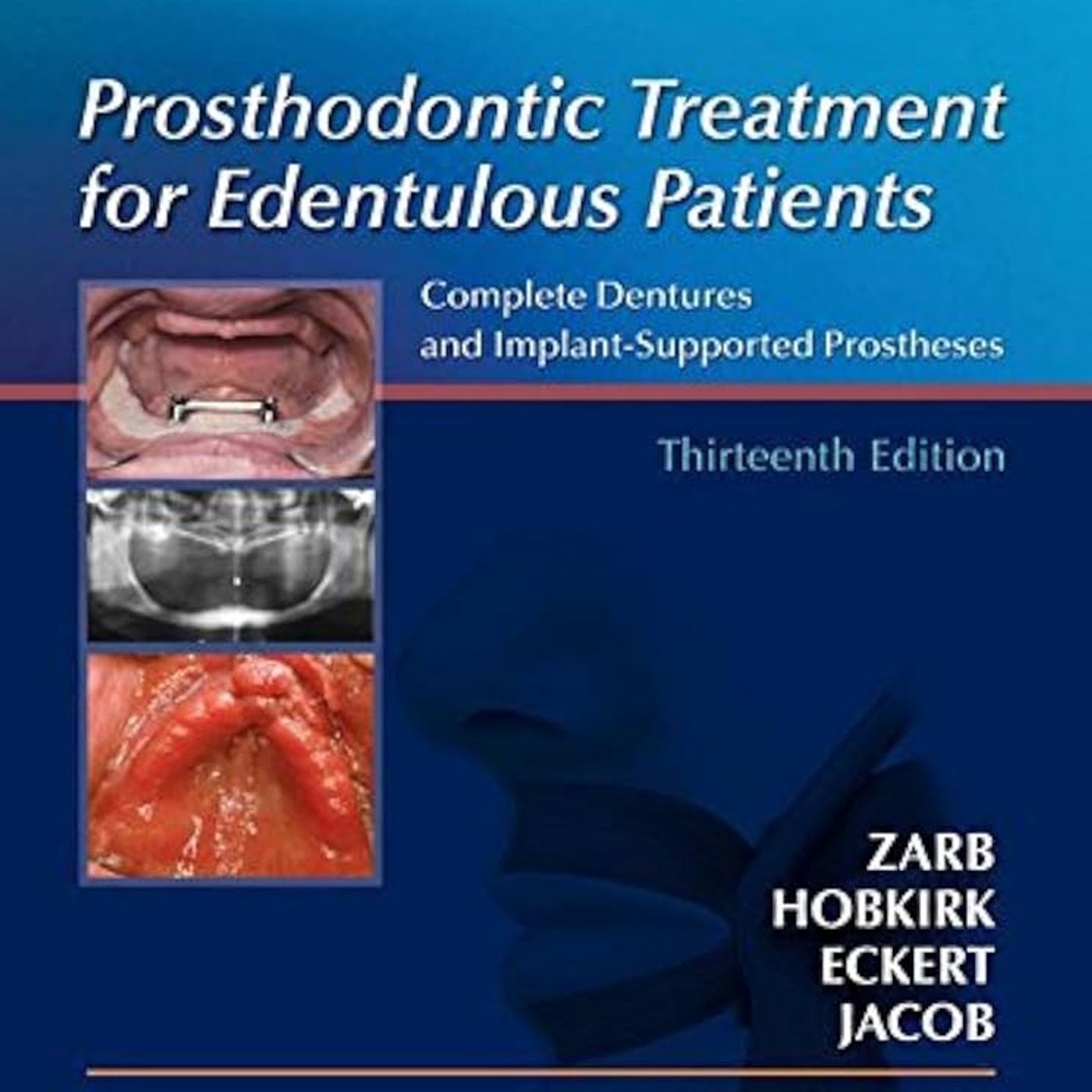 Prosthodontic Treatment for Edentulous Patients: Complete Dentures and Implant-Supported Prostheses