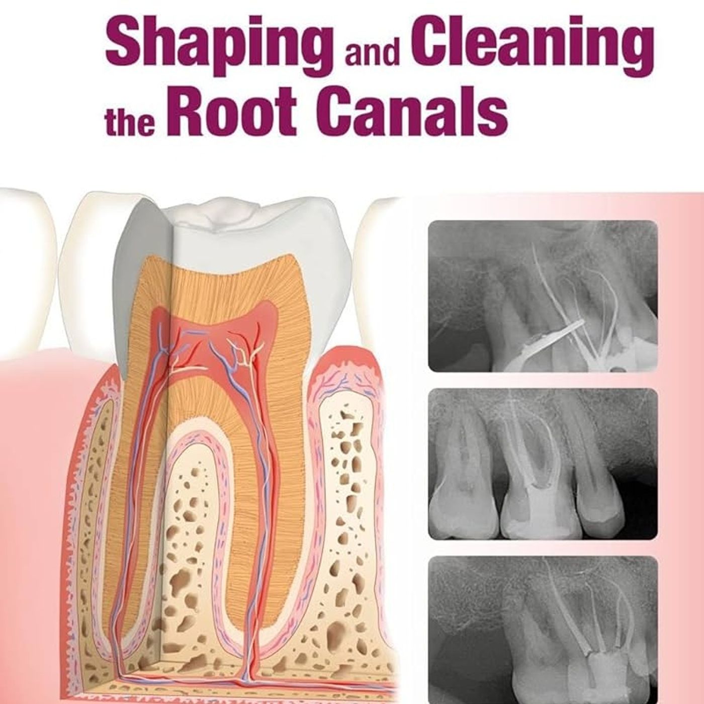 Shaping and Cleaning the Root Canals