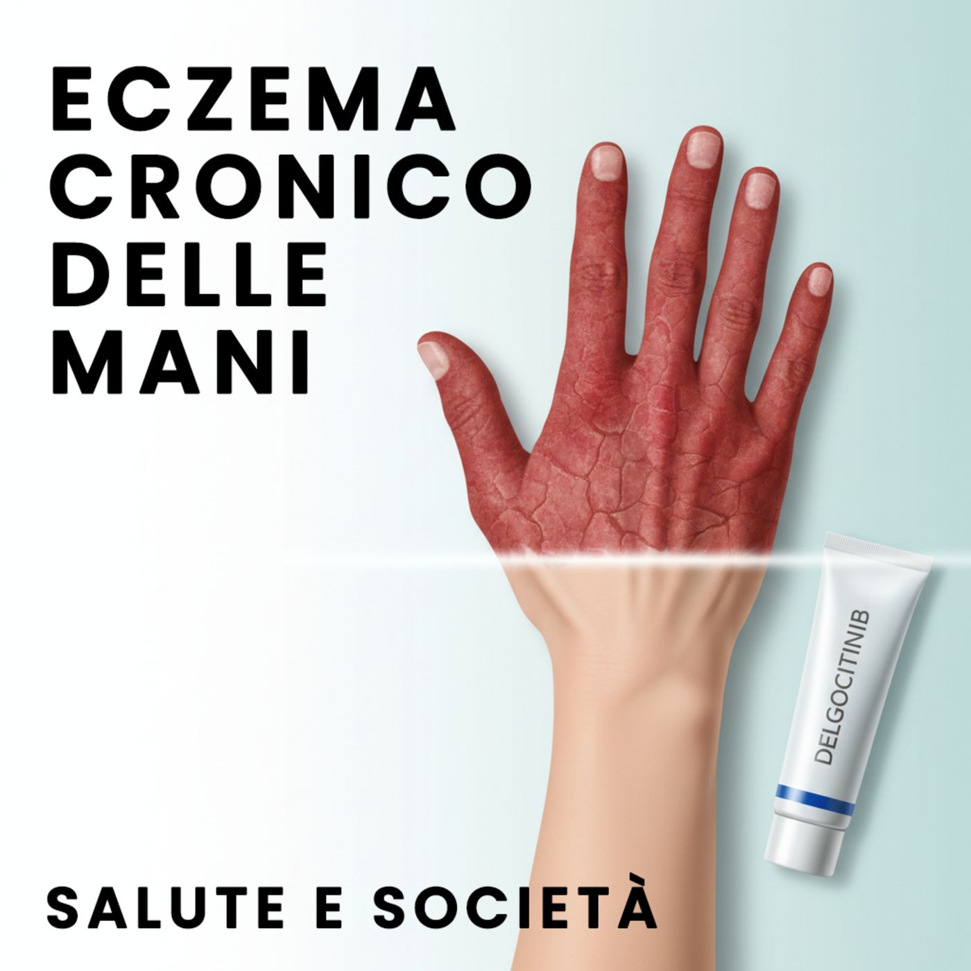 Delgocitinib è ora disponibile in Italia per l'eczema cronico delle mani episode artwork