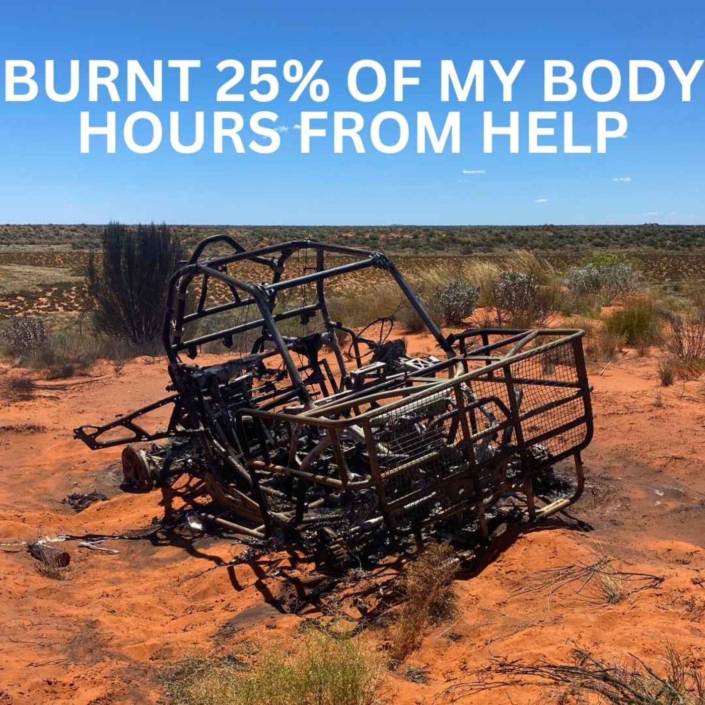 Burnt 25% Of My Body Hours From Help