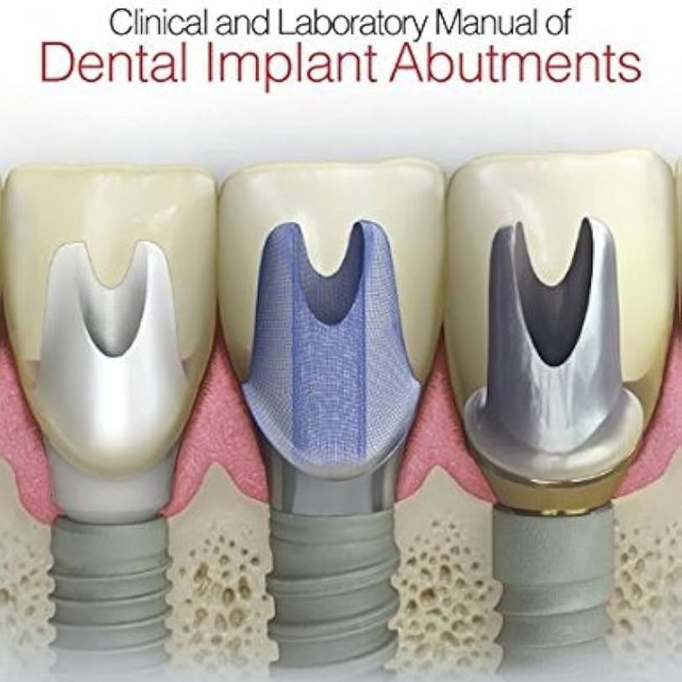 Clinical and Laboratory Manual of Dental Implant Abutments