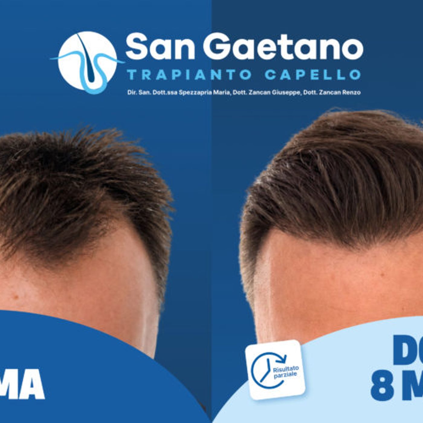 Perdita di capelli? Il trapianto può aiutarti a ritrovare sicurezza episode artwork