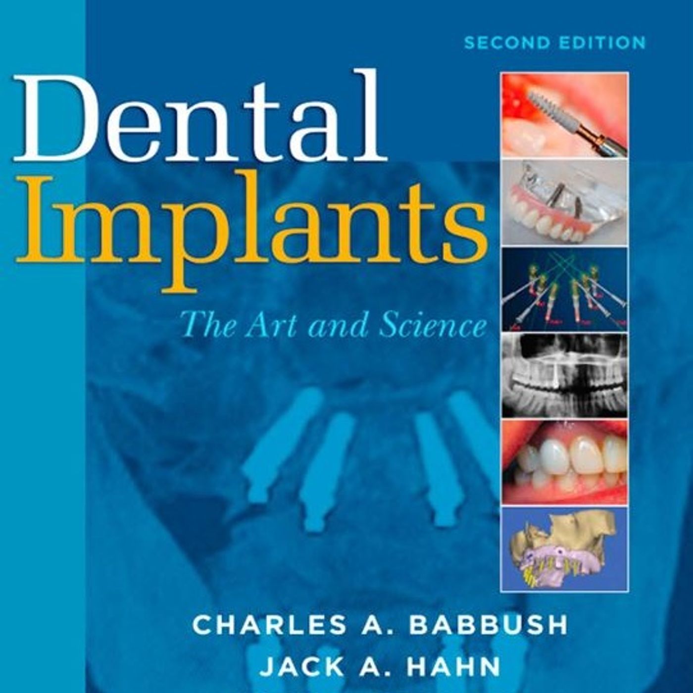 Dental Implant: The Art and Science