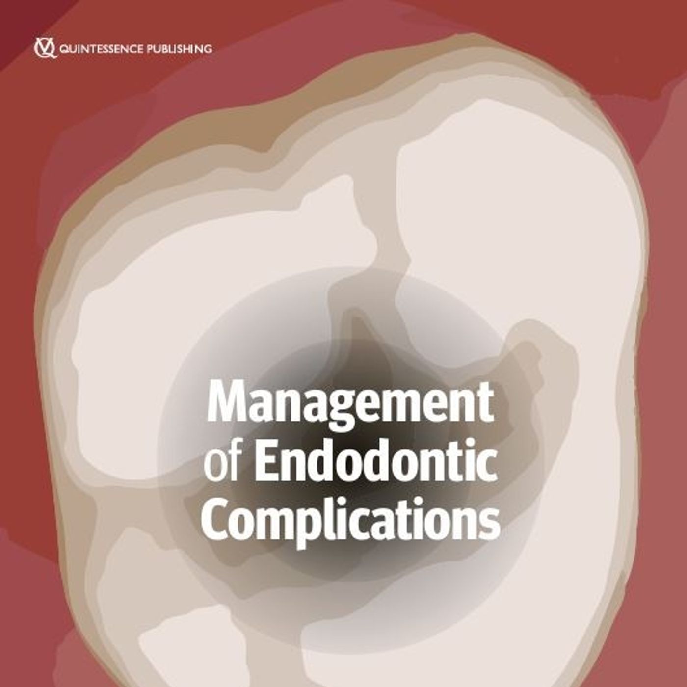 Management of Endodontic Complications: From Diagnosis to Prognosis