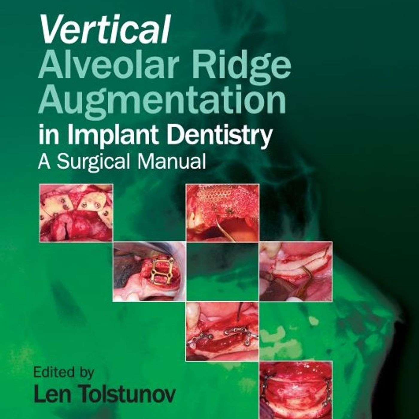 Vertical Alveolar Ridge Augmentation in Implant Dentistry:  A Surgical Manual