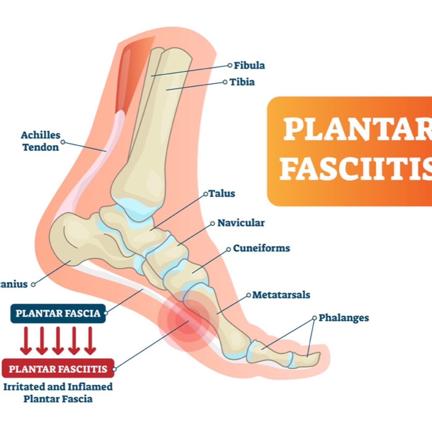 Plantar Fasciitis