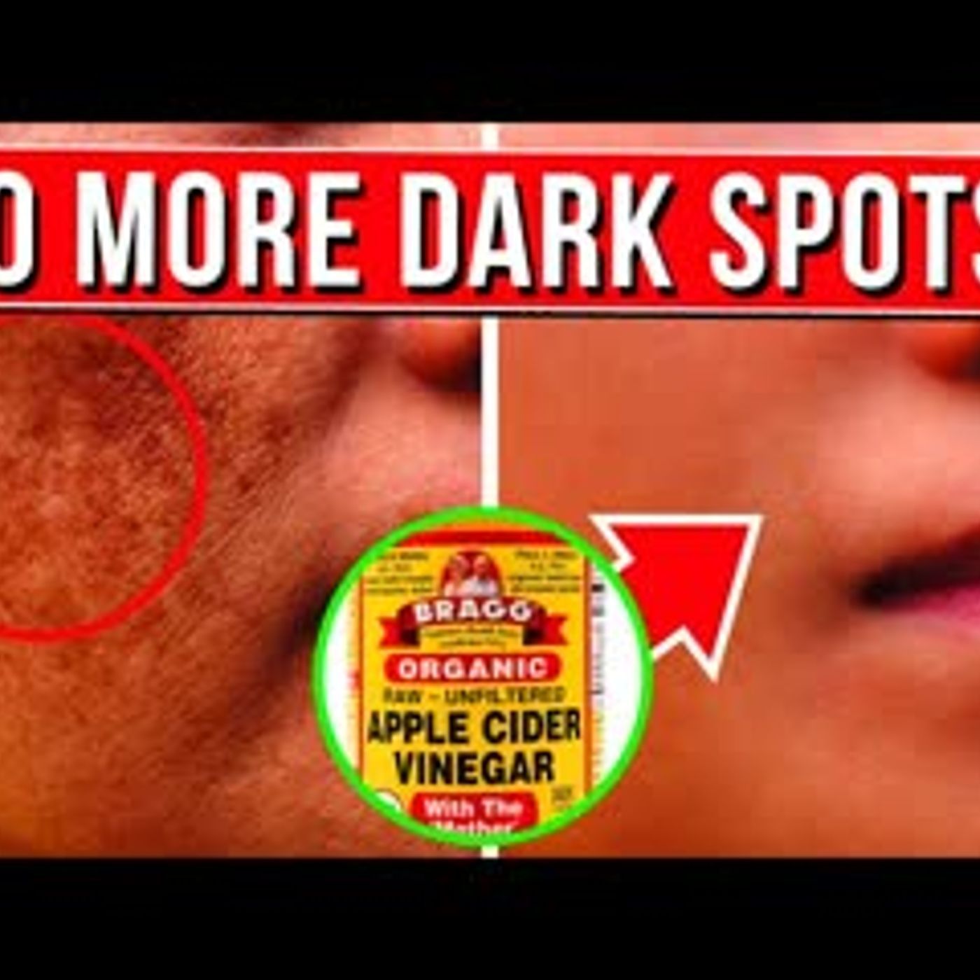 10 POWERFUL Remedies To Remove Skin Blemishes & Pigmentation Naturally episode artwork