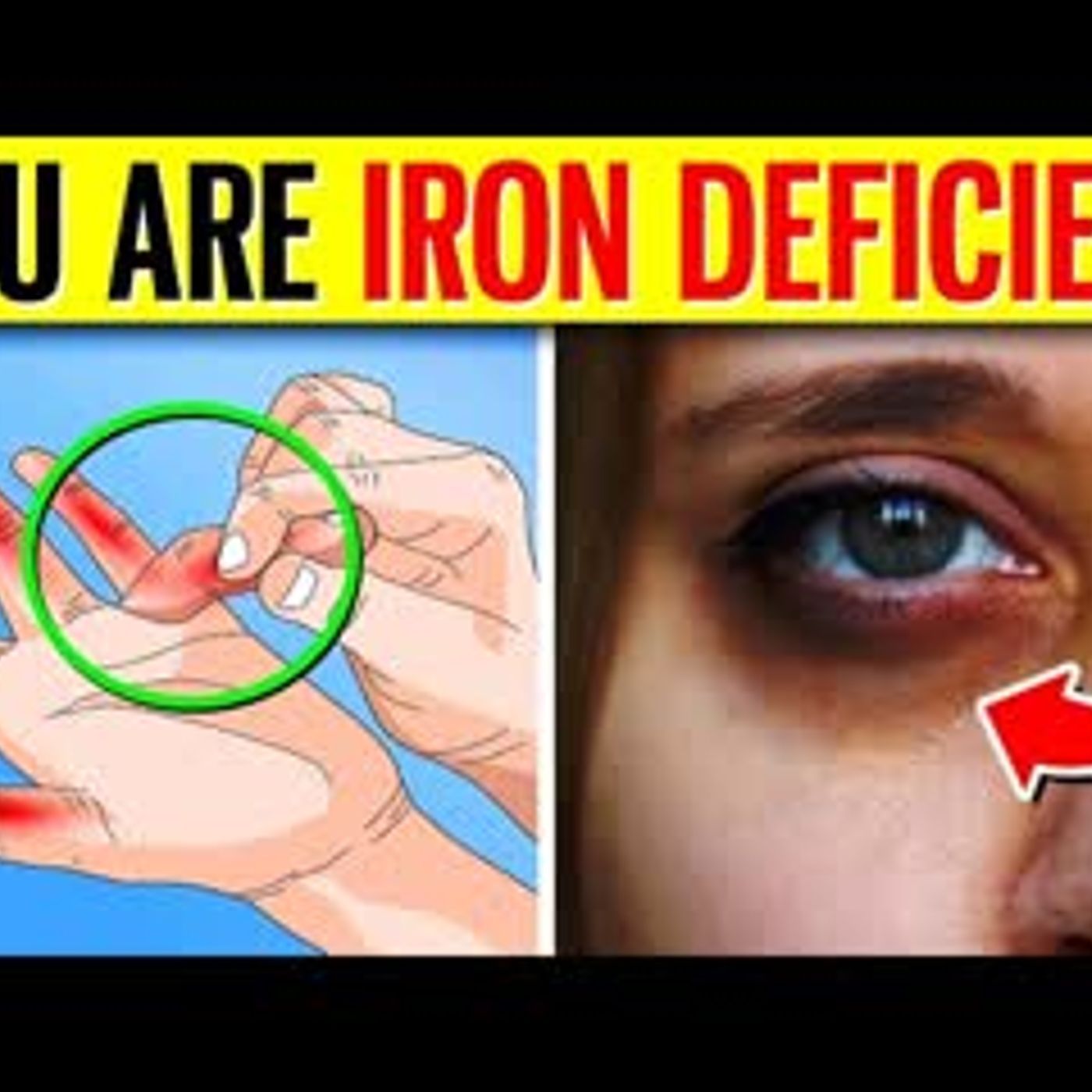 10 ALARMING Signs You Have An Iron Deficiency! (Anemia) episode artwork