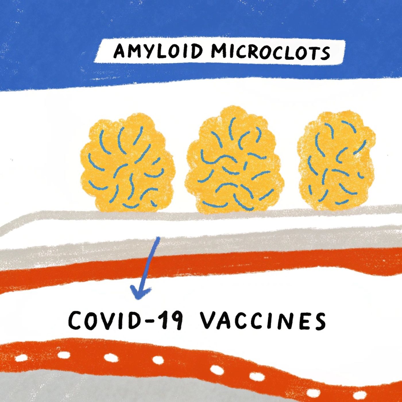 Amyloid Microclots Linked to Covid-19 Vaccines