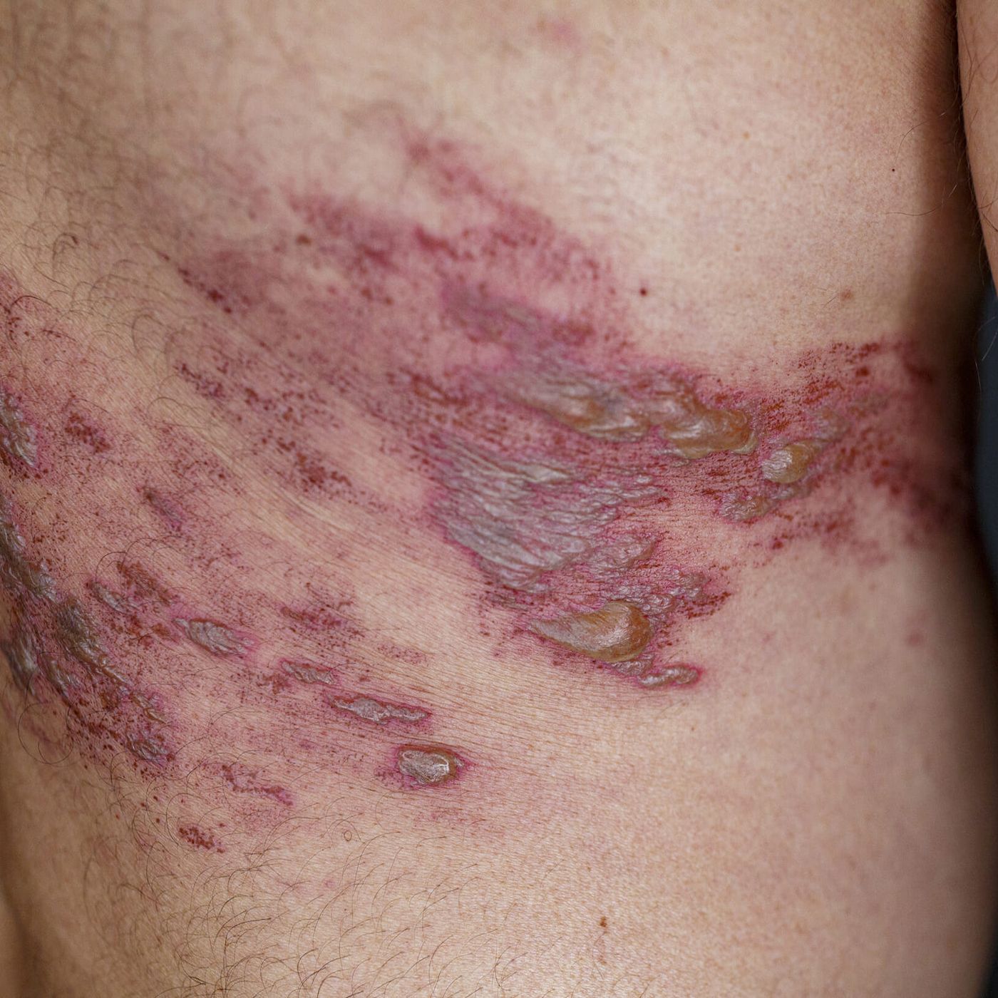 Herpes Zóster - Cobreiro episode artwork