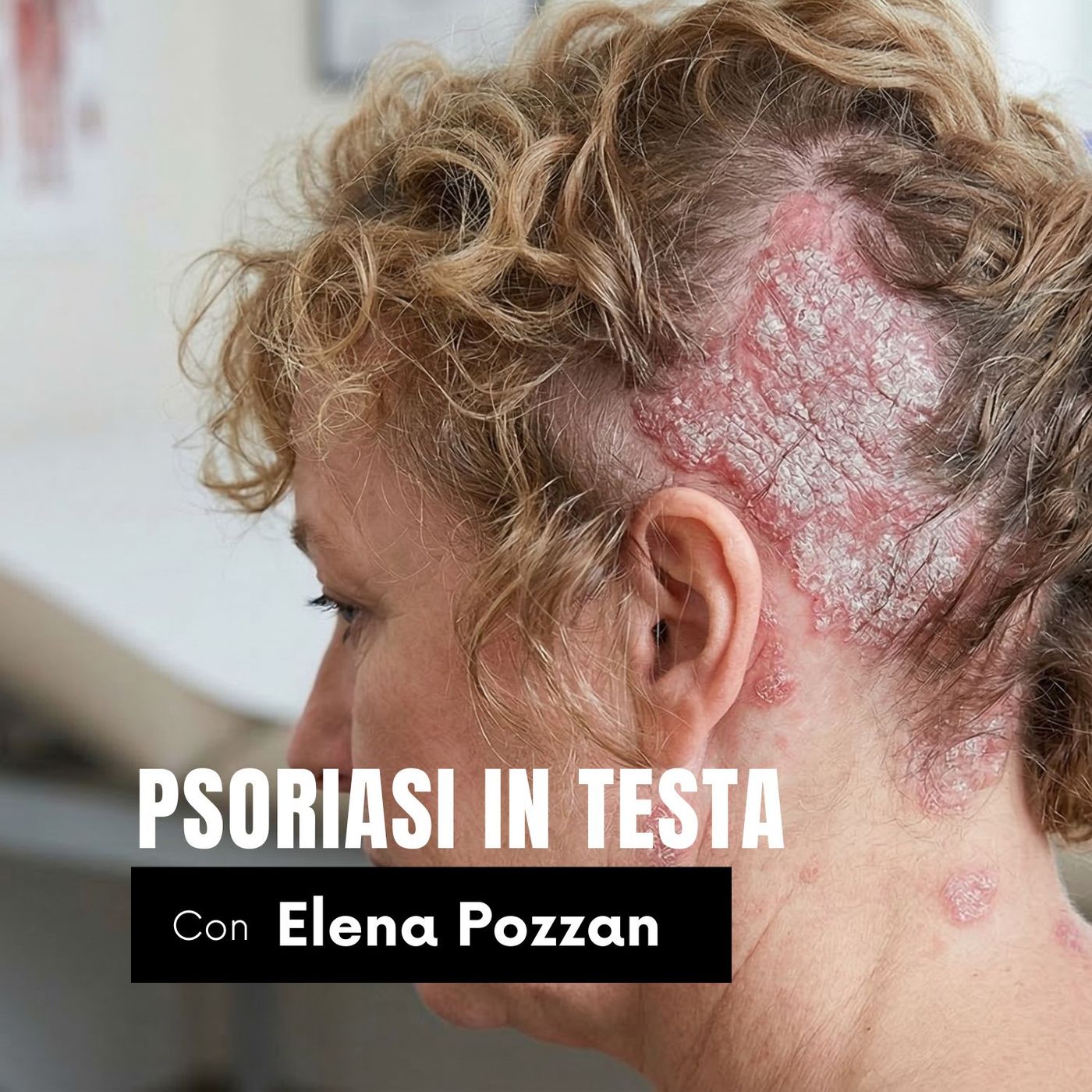 PSORIASI IN TESTA episode artwork