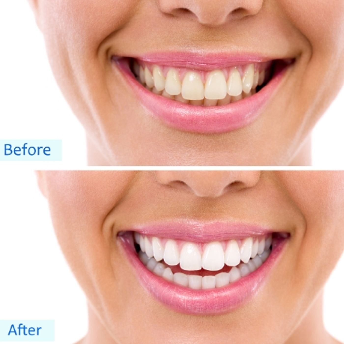90-Minute Premium Teeth Whitening