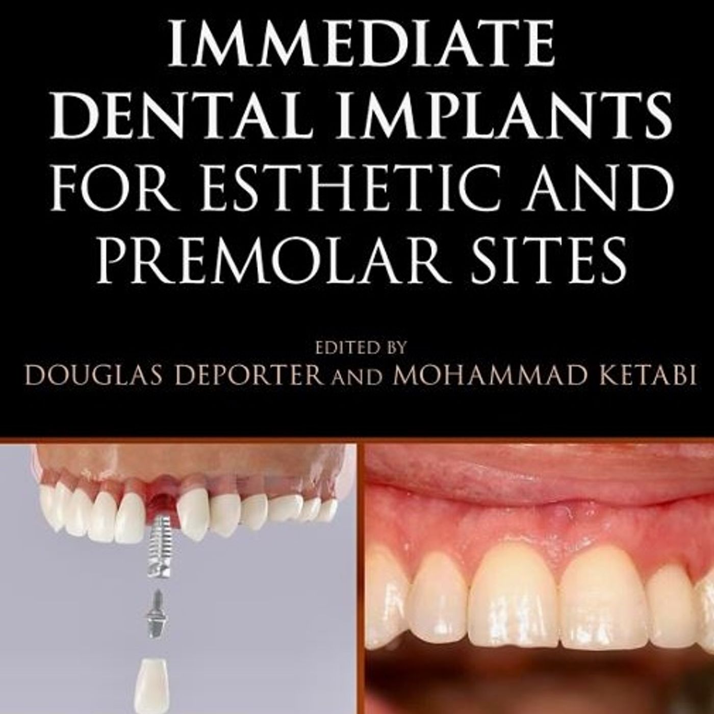 Immediate Dental Implants for Esthetic and Premolar Sites
