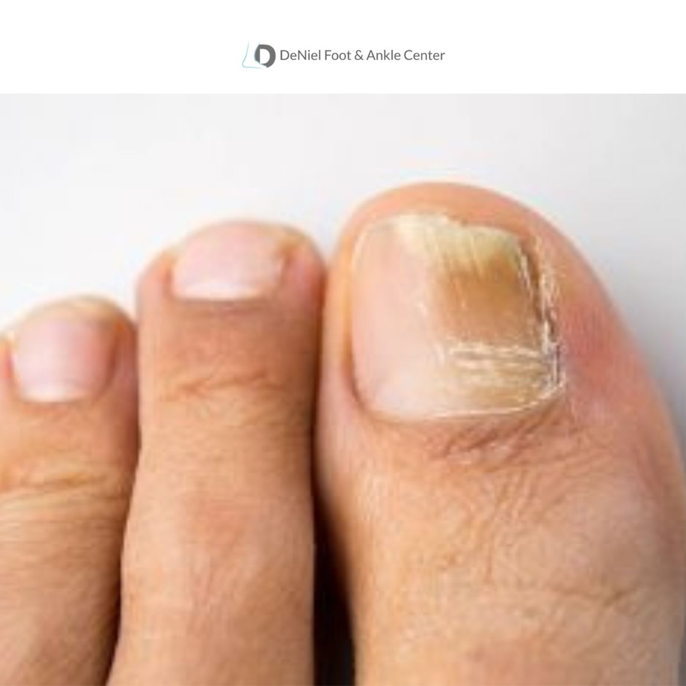 White Marks on Toenails Causes and Prevention Tips episode artwork