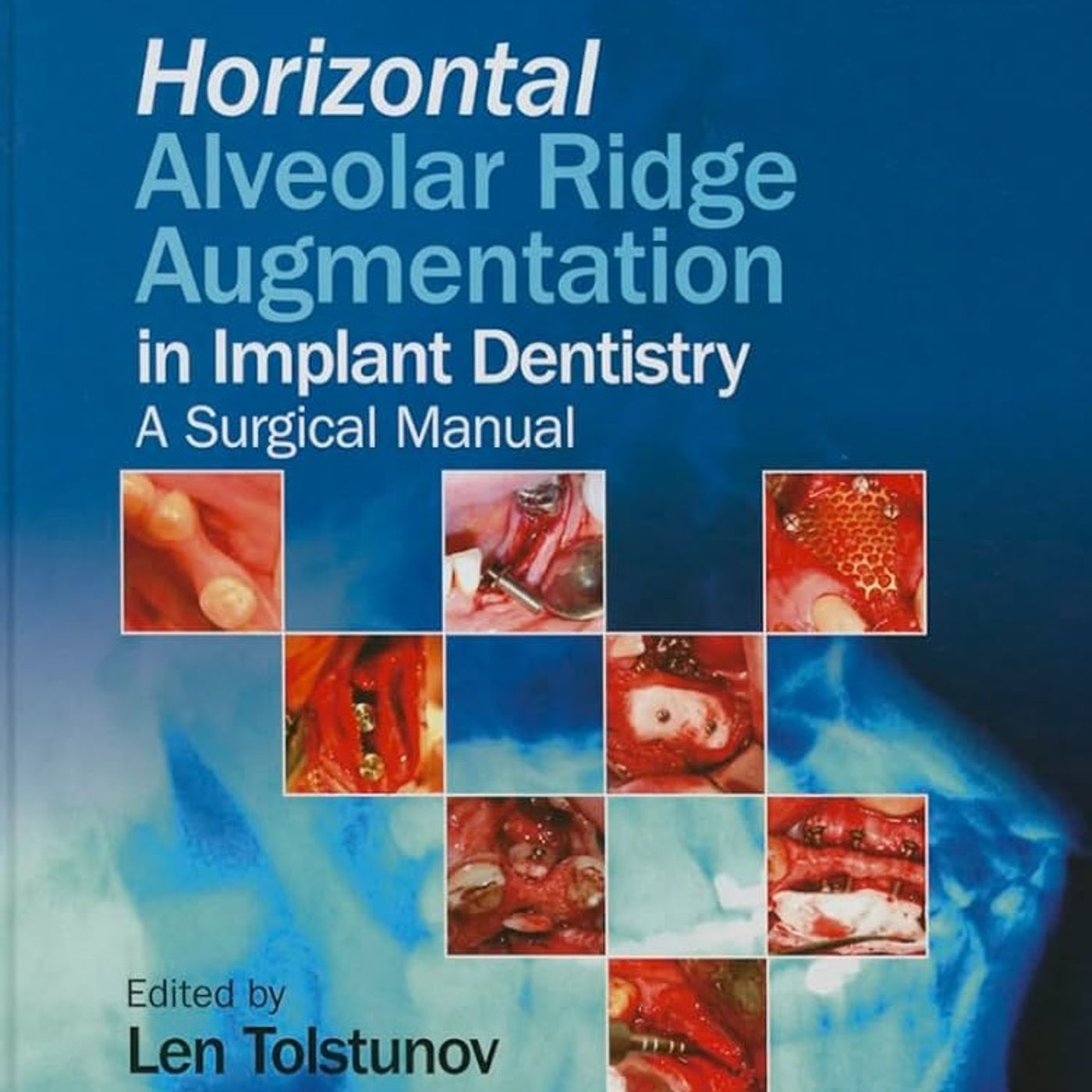 Horizontal Alveolar Ridge Augmentation in Implant Dentistry: A Surgical Manual