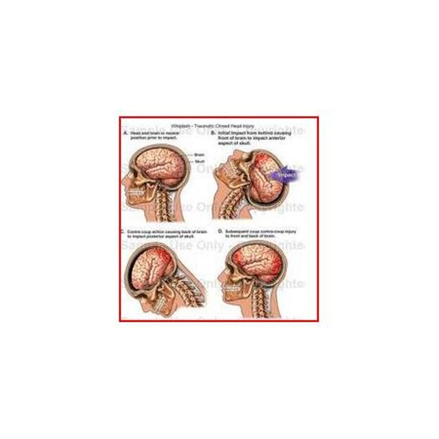 Dream Catchers – Preventing TBI Meltdowns – Les Paul episode artwork