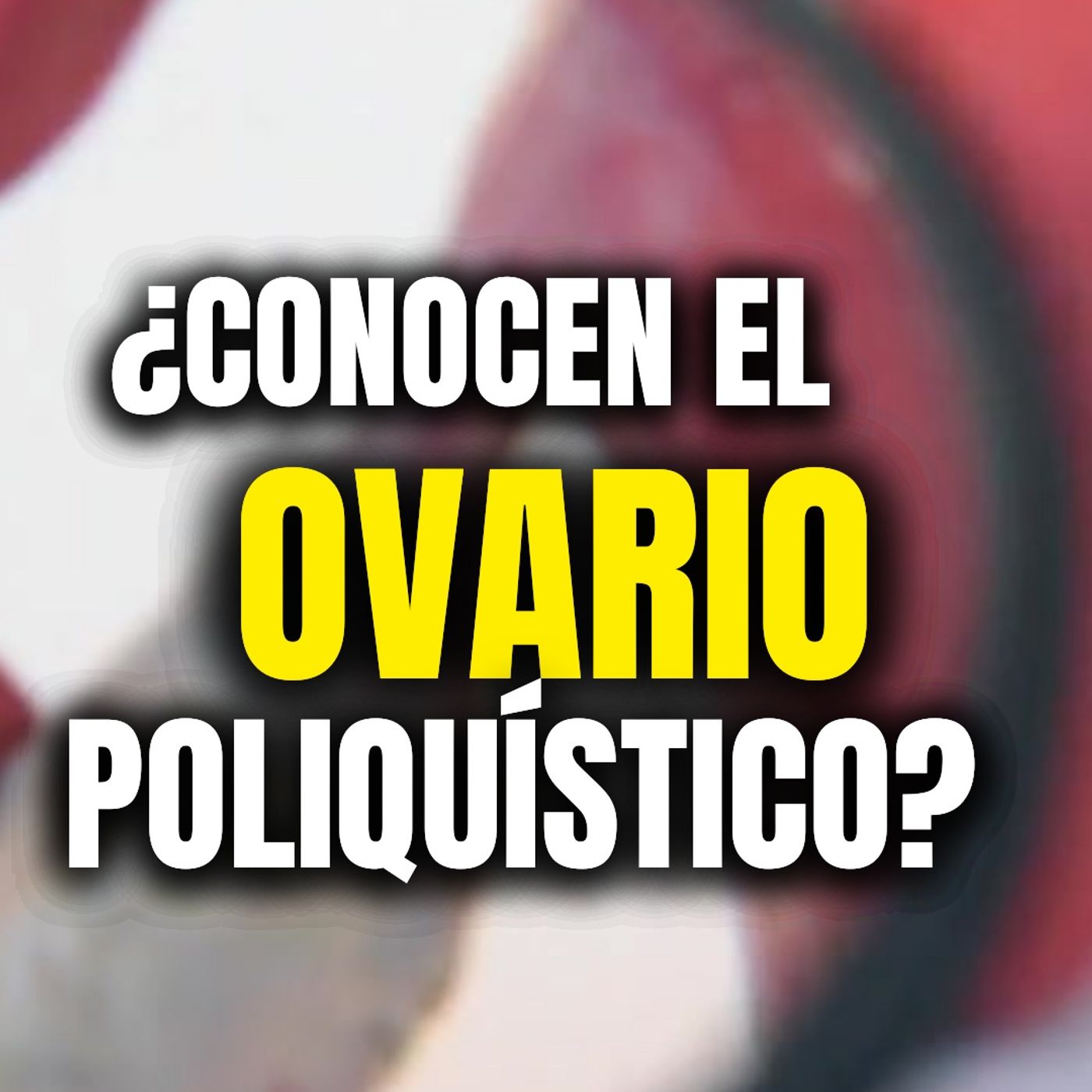 🚺💊El síndrome de ovario poliquístico (SOP) es un trastorno hormonal que afecta a millones de mujeres en todo el mundo.