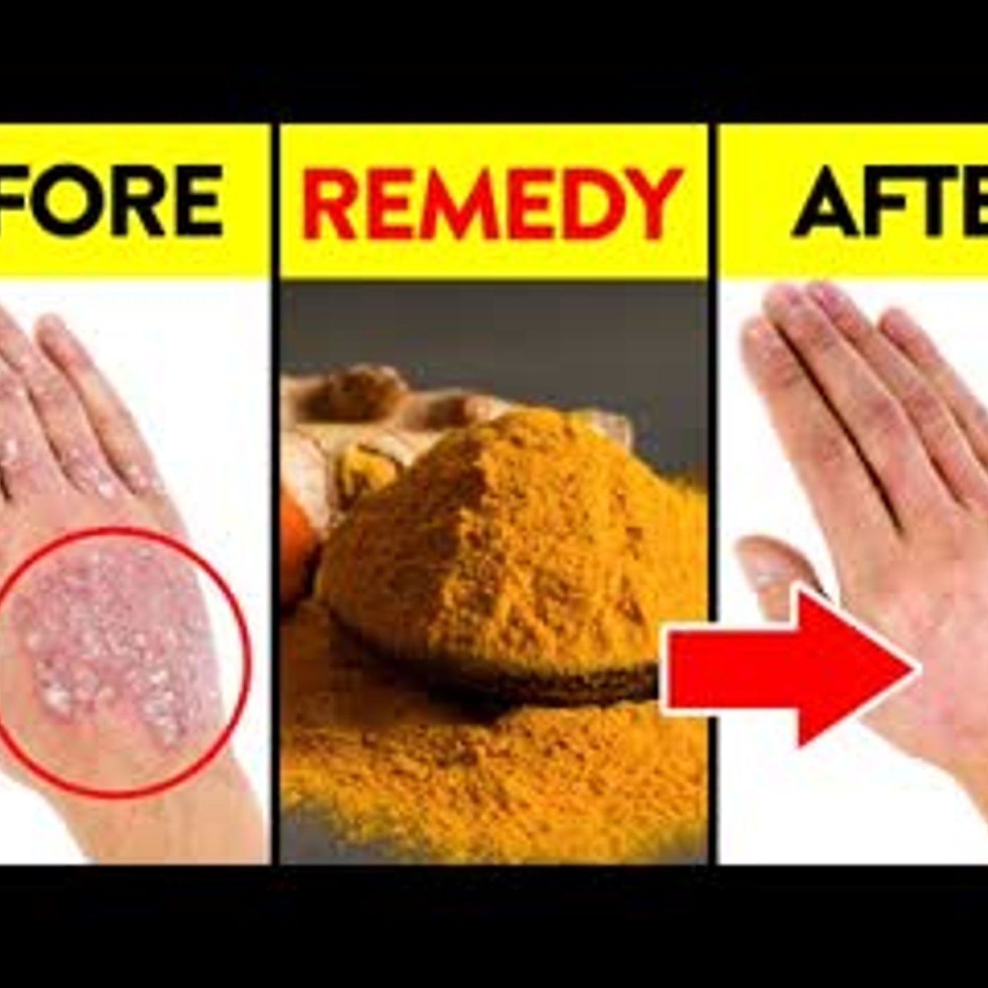 13 Remedies To Treat Psoriatic Arthritis Naturally episode artwork