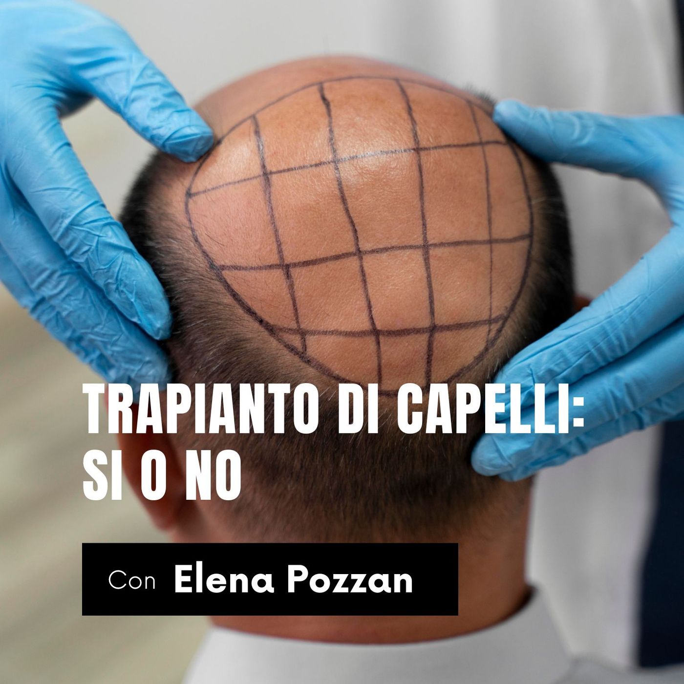Trapianto di capelli: Si' o No episode artwork