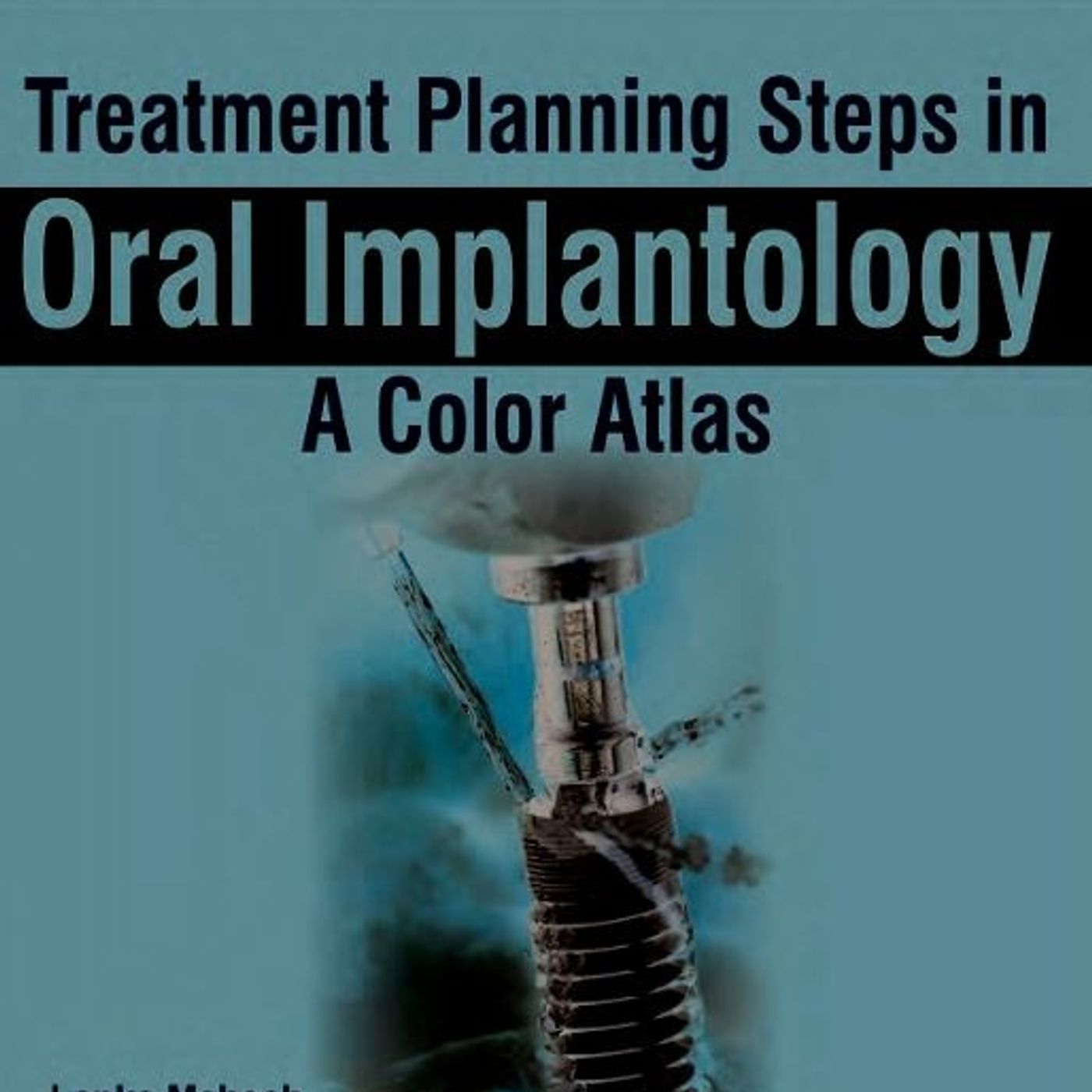 Treatment Planning Steps in Oral Implantology: A Color Atlas