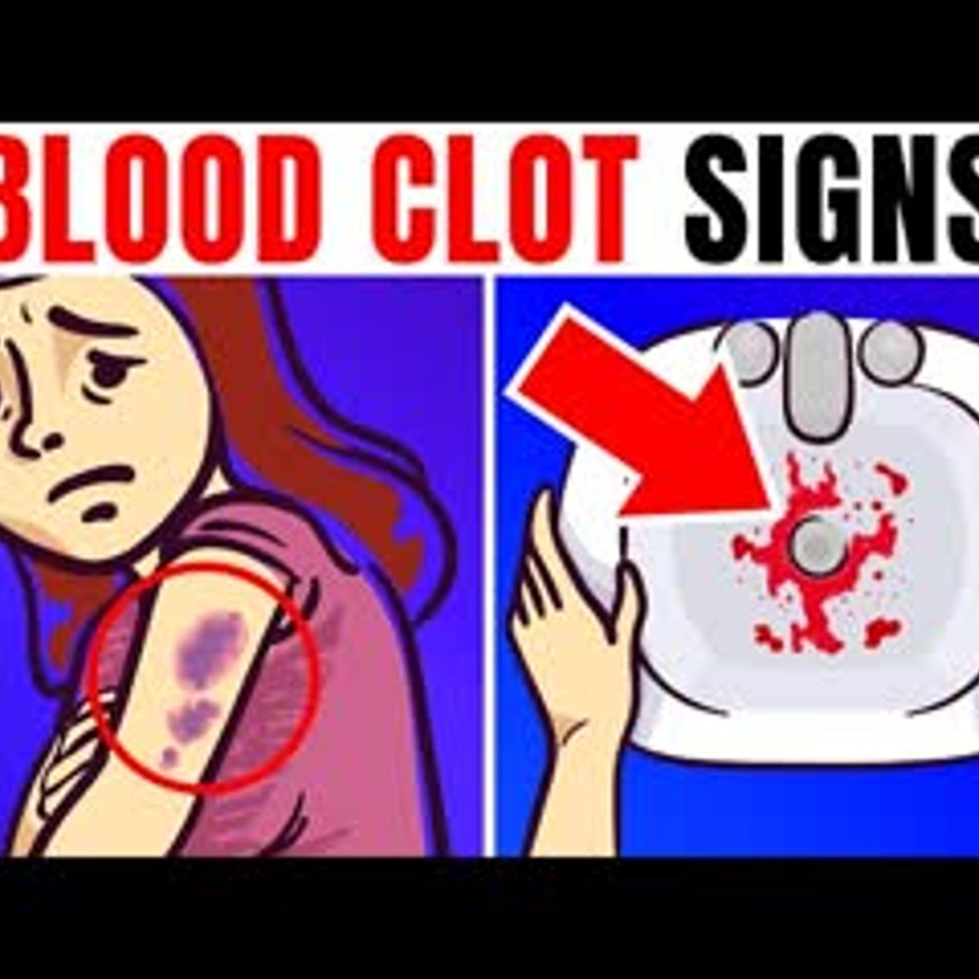 13 Scary Signs You May Have A Blood Clot episode artwork