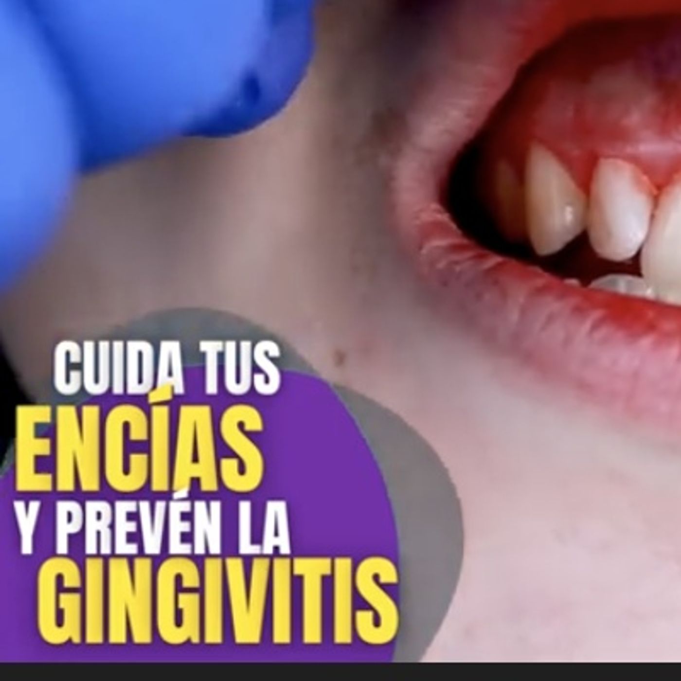 Gingivitis:  El enemigo silencioso de tus encías. 🦷