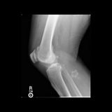 Terry Lovelace - Assistant A.G. Abducted by Aliens and Implant Behind his Knee..