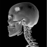 Survival Medicine Podcast: Brain Trauma, Bee Stings, Paxlovid, Wound Care