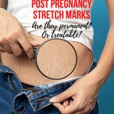 how to stop stretch marks