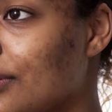 Tretiheal Tretinoin Cream: The Affordable Skincare Secret You Can Buy Online