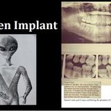 An Alien Implant