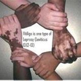 BIBLE LEPROSY-ORIGIN OF WHITE SKIN (Albinism & Vitiligo) PT2