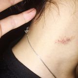 How to Get Rid of a Hickey Quick Tips for Faster Healing