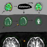 Detecting Alzheimer's 20 Years Before Symptoms: The Hidden Roadmap