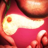 Câncer de Pâncreas