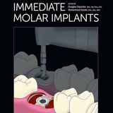Immediate Molar Implants